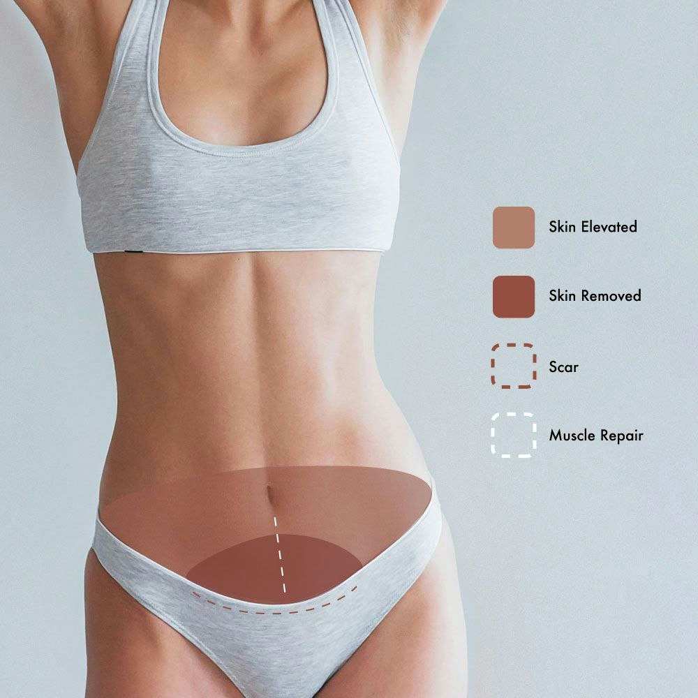 Mini Tummy Tuck