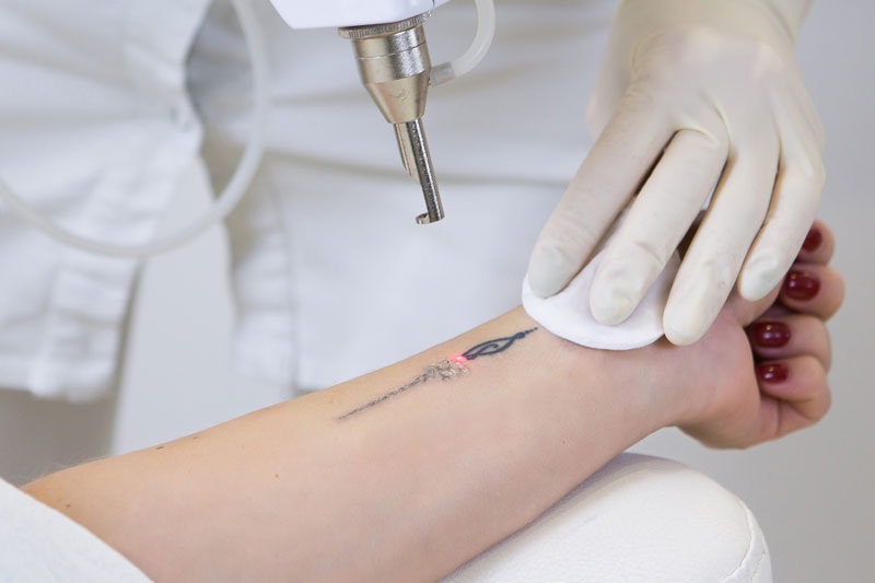 laser tattoo removal on a forearm