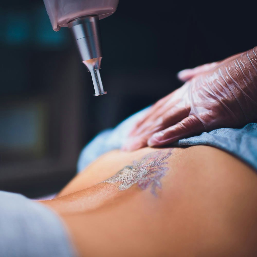 laser tattoo removal