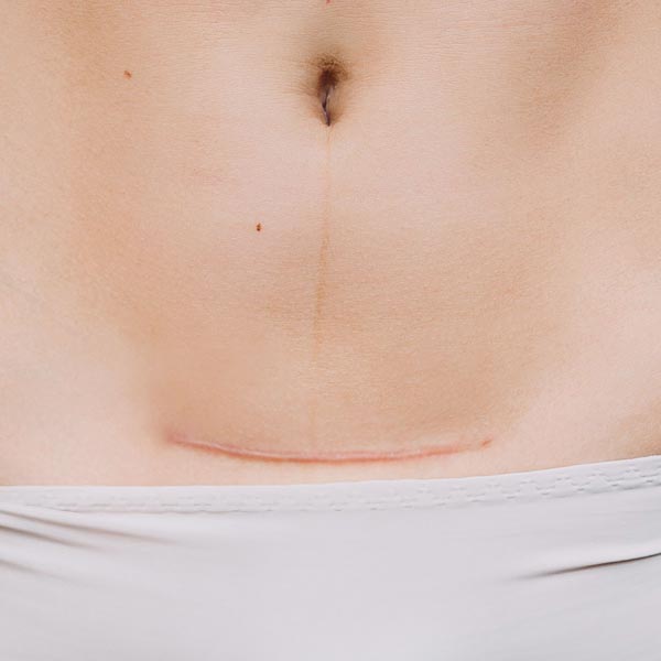 C-section scars