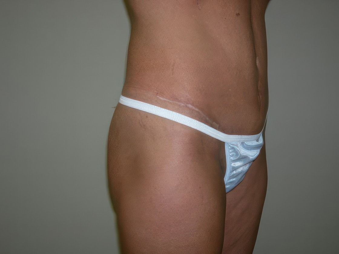 Dr. Ashish K. Jain's patient after tummy tuck