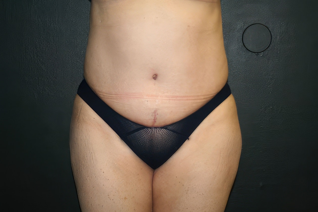 Dr. Ashish K. Jain's patient after tummy tuck