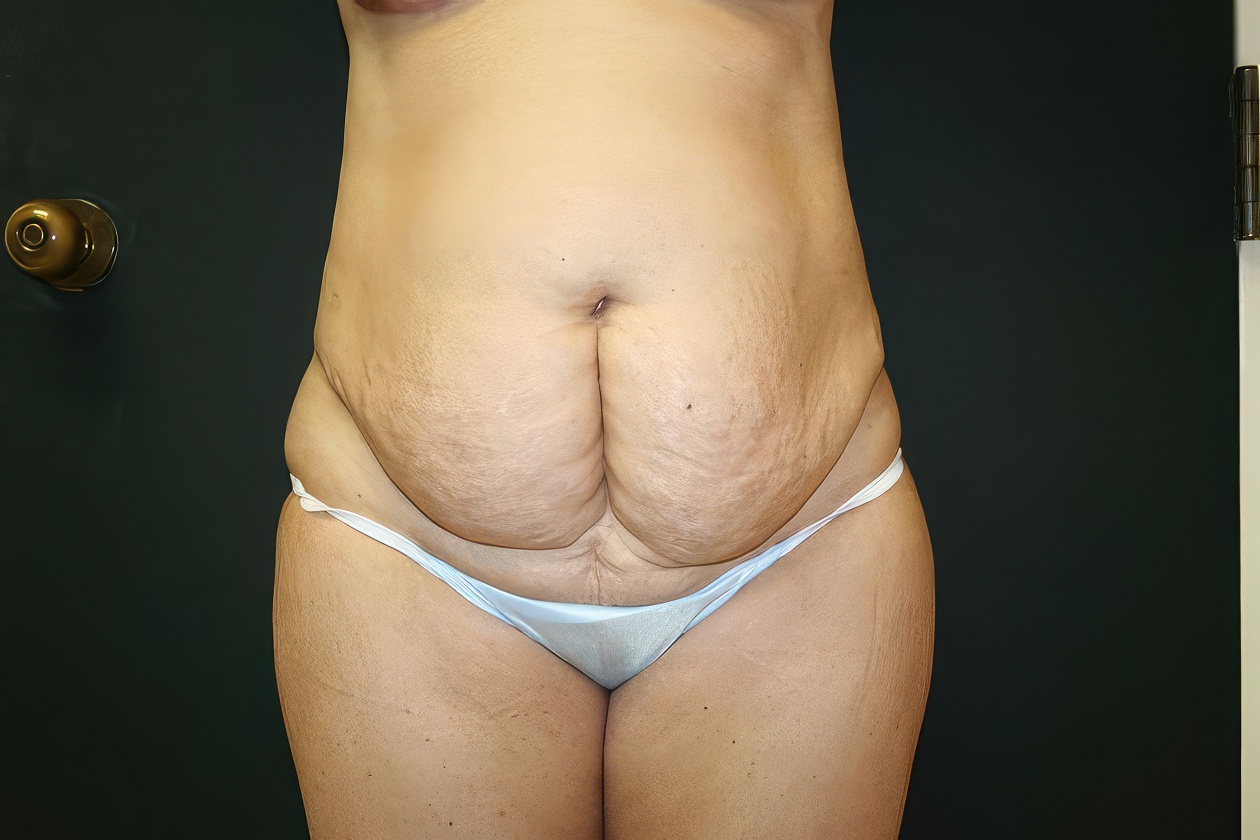 Dr. Ashish K. Jain's patient before tummy tuck