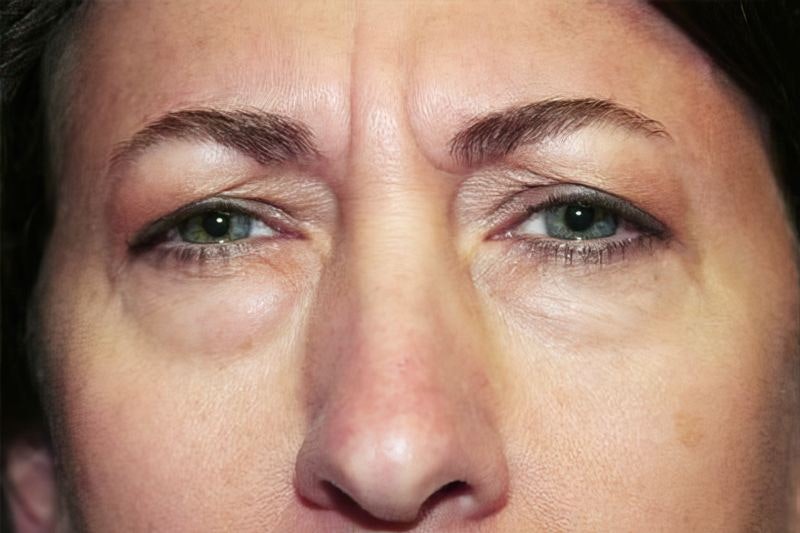 Dr. Jain's patient before Blepharoplasty