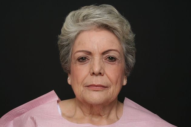 Dr. Ashish K. Jain's patient before facelift