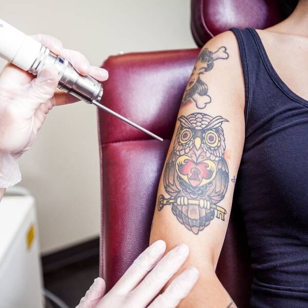 a tattoo removal laser near a woman with tattoos