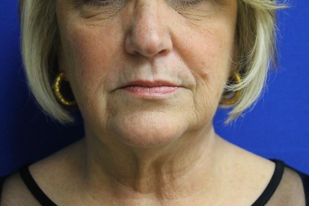 Dr. Spencer R. Anderson's patient after treatment