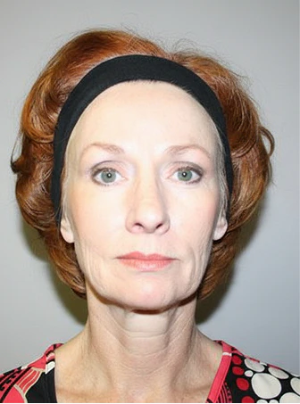 Patient before facelift