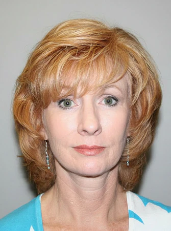 Patient after facelift