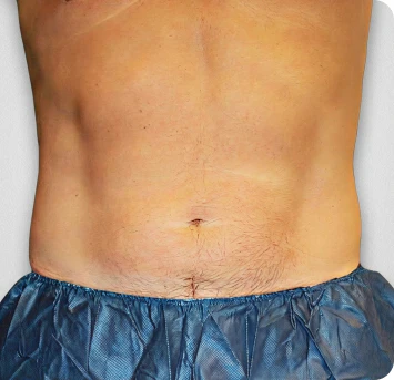 after coolsculpting