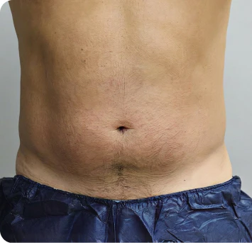 before coolsculpting