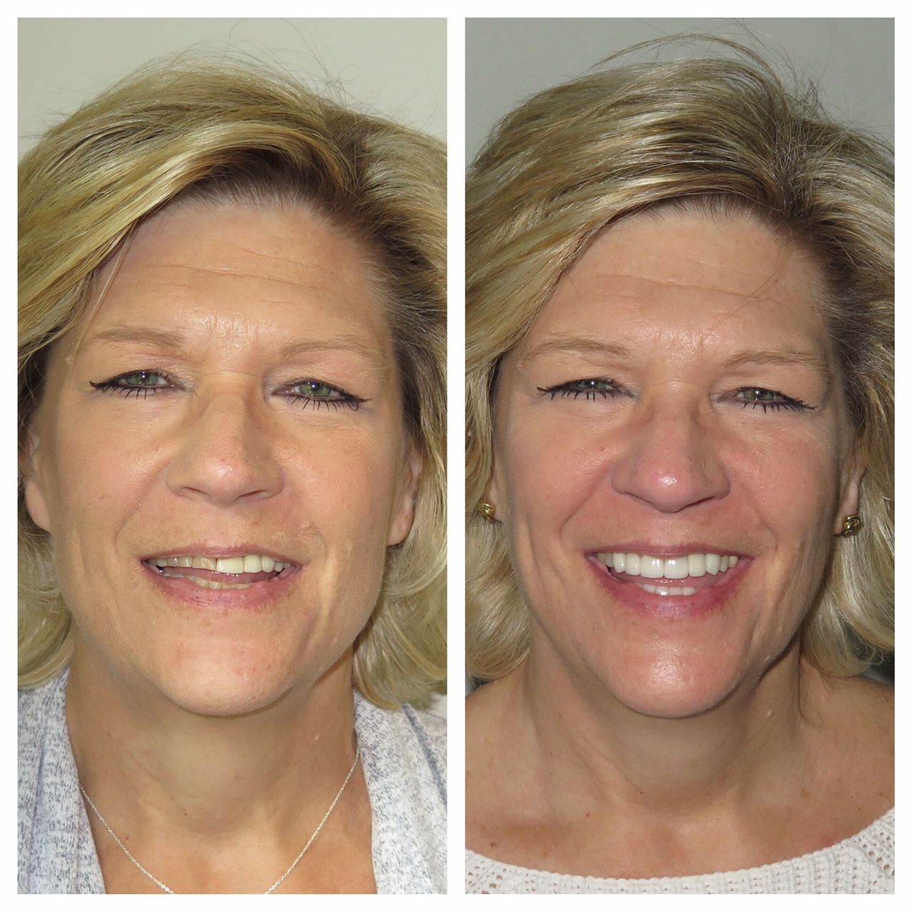 Before and after veneers