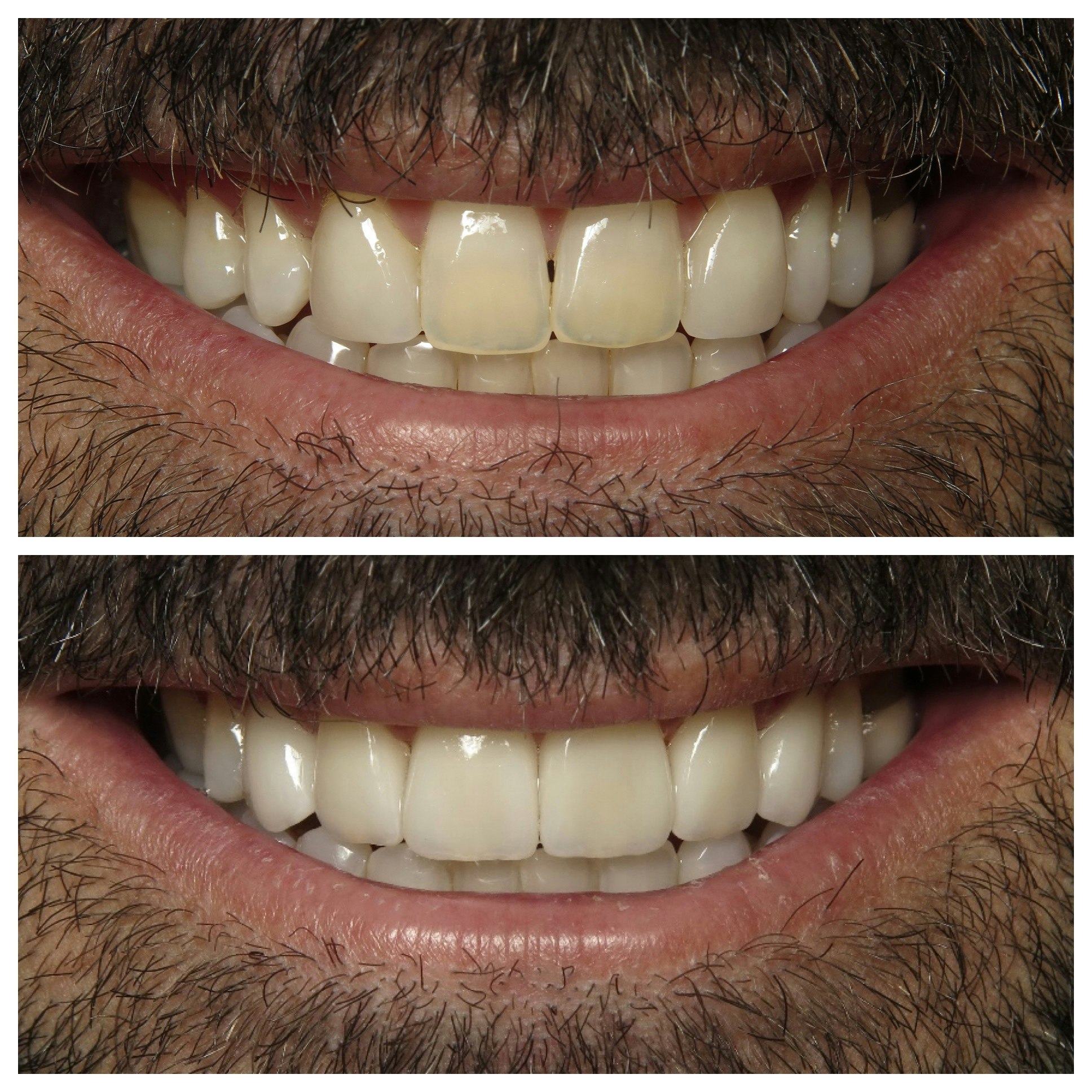 Before and after of man's smile