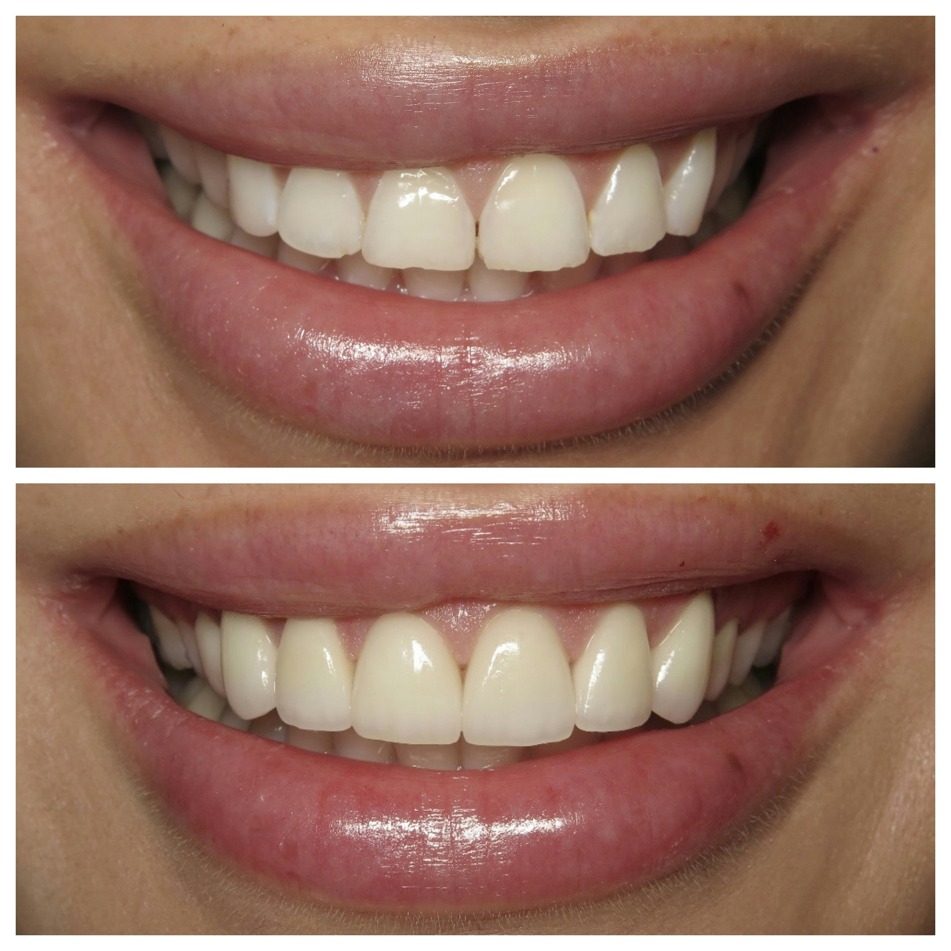 Before and after of woman's smile