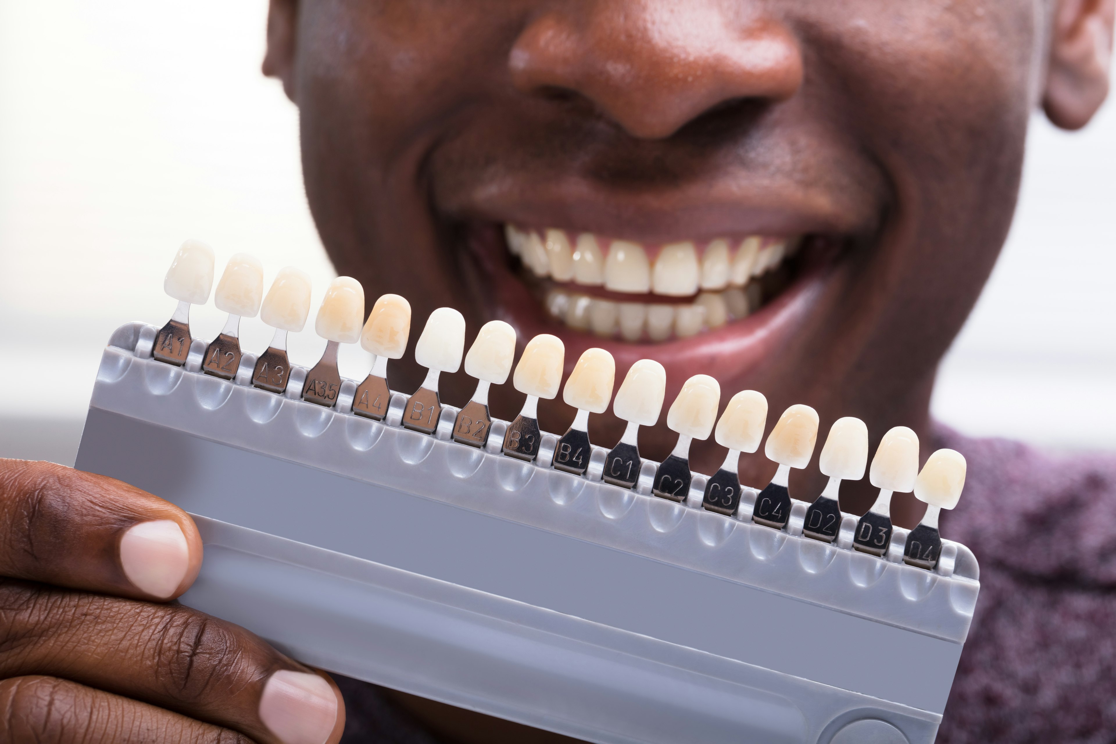 veneer shade and color variations compared to actual teeth
