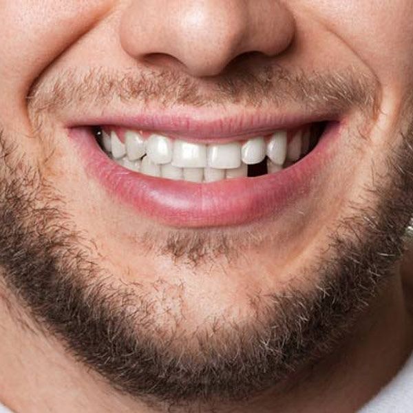 Smiling man missing a tooth
