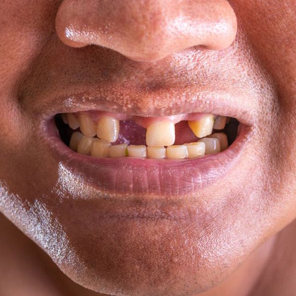 Man missing two front teeth