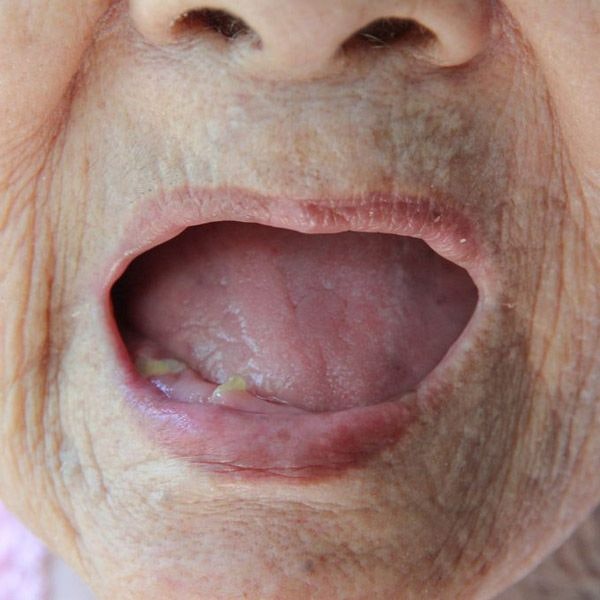 Woman missing all her teeth