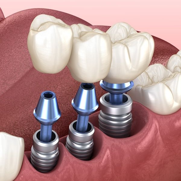 Implant-supported bridge