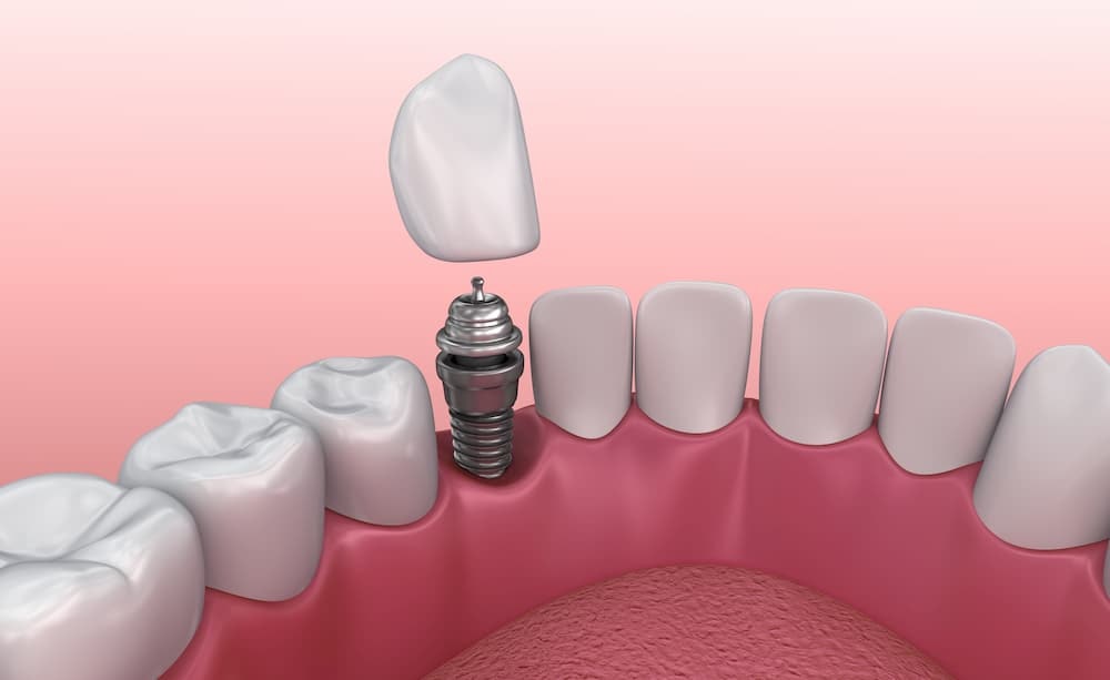 Dental Implants
