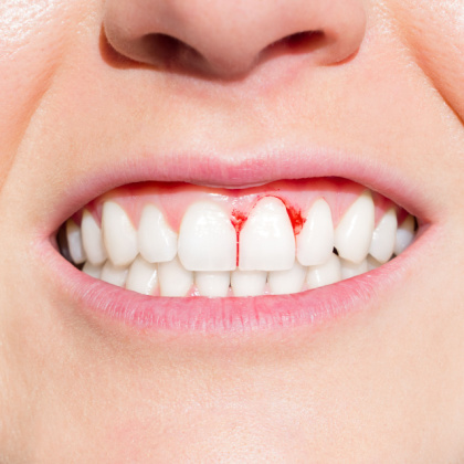 bloody gums and smile