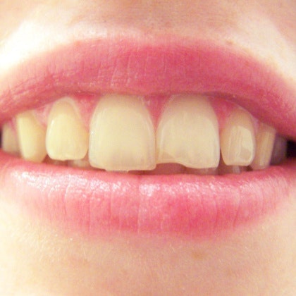 chipped front tooth