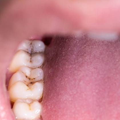 back teeth with cavities