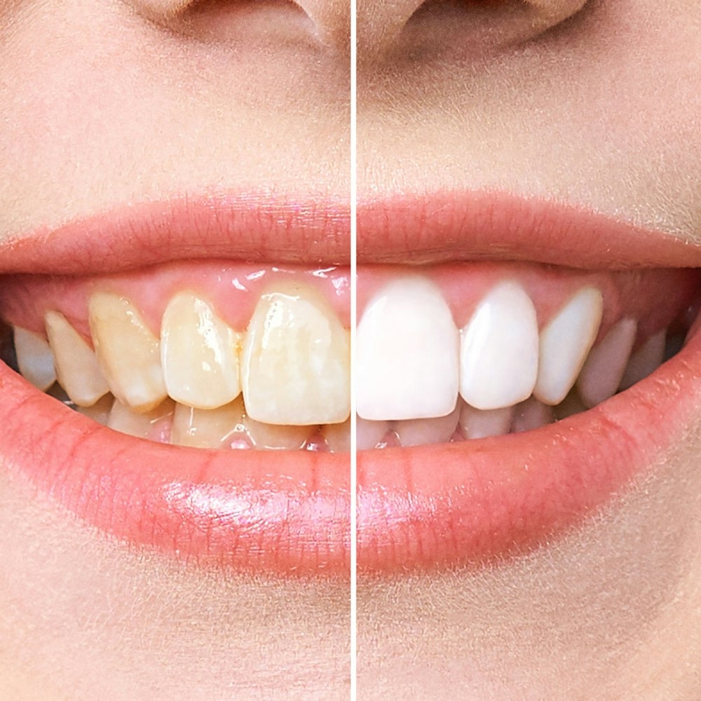 Before and after teeth whitening