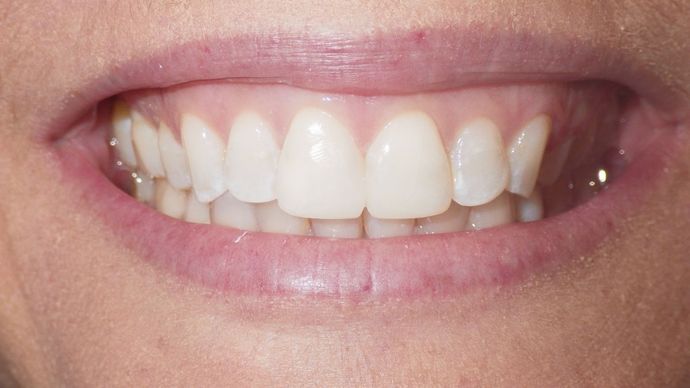 After smile makeover