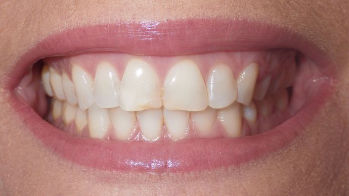 Before smile makeover