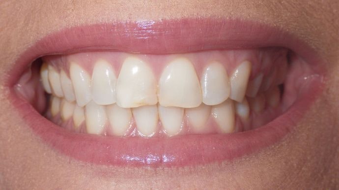 Before smile makeover