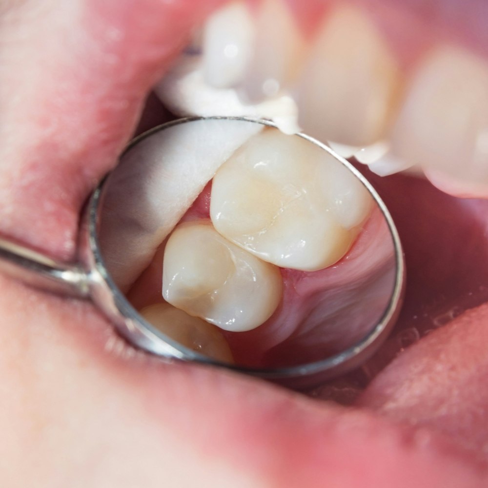 Tooth colored fillings