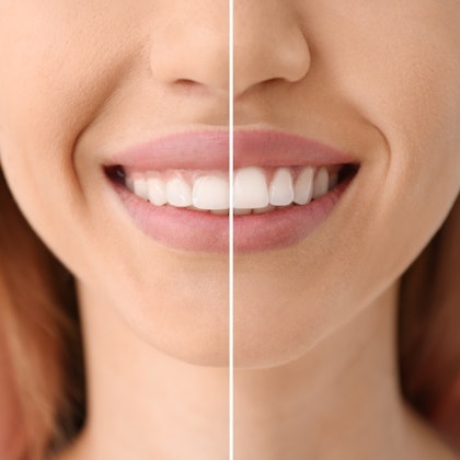 Before and after gum contouring