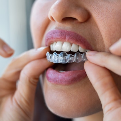 Closeup of woman placing her clear aligner