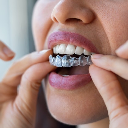 Closeup of woman placing her clear aligner