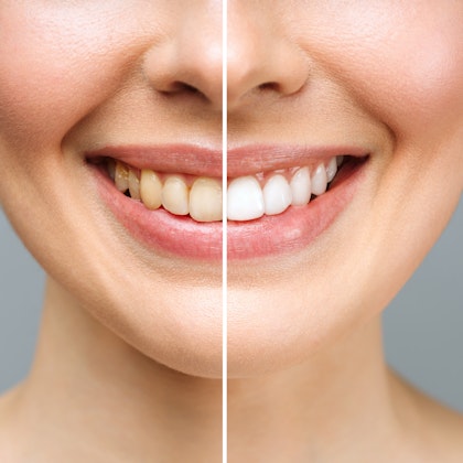 Before and after teeth whitening