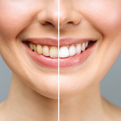 Before and after teeth whitening