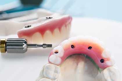 close up of an implant denture