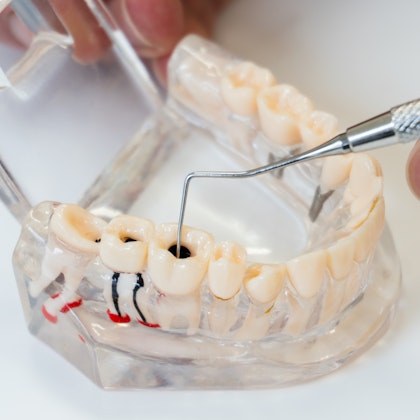 Root canal model