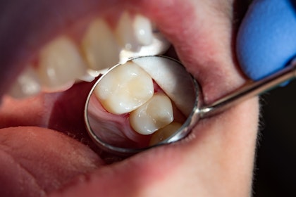 close up of tooth after dental filling