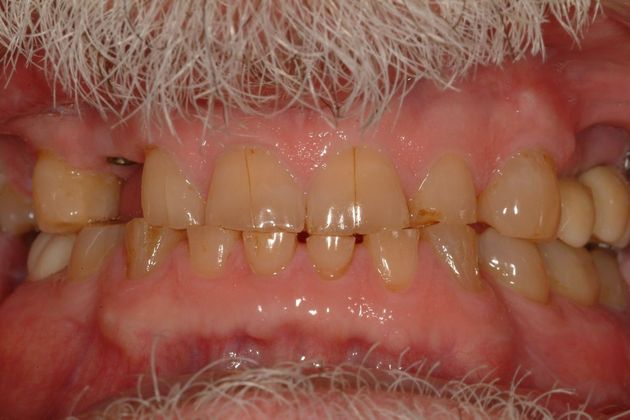 Dr. Michael Haight's FMR patient before treatment