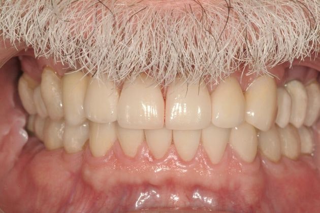 Dr. Michael Haight's FMR patient after treatment