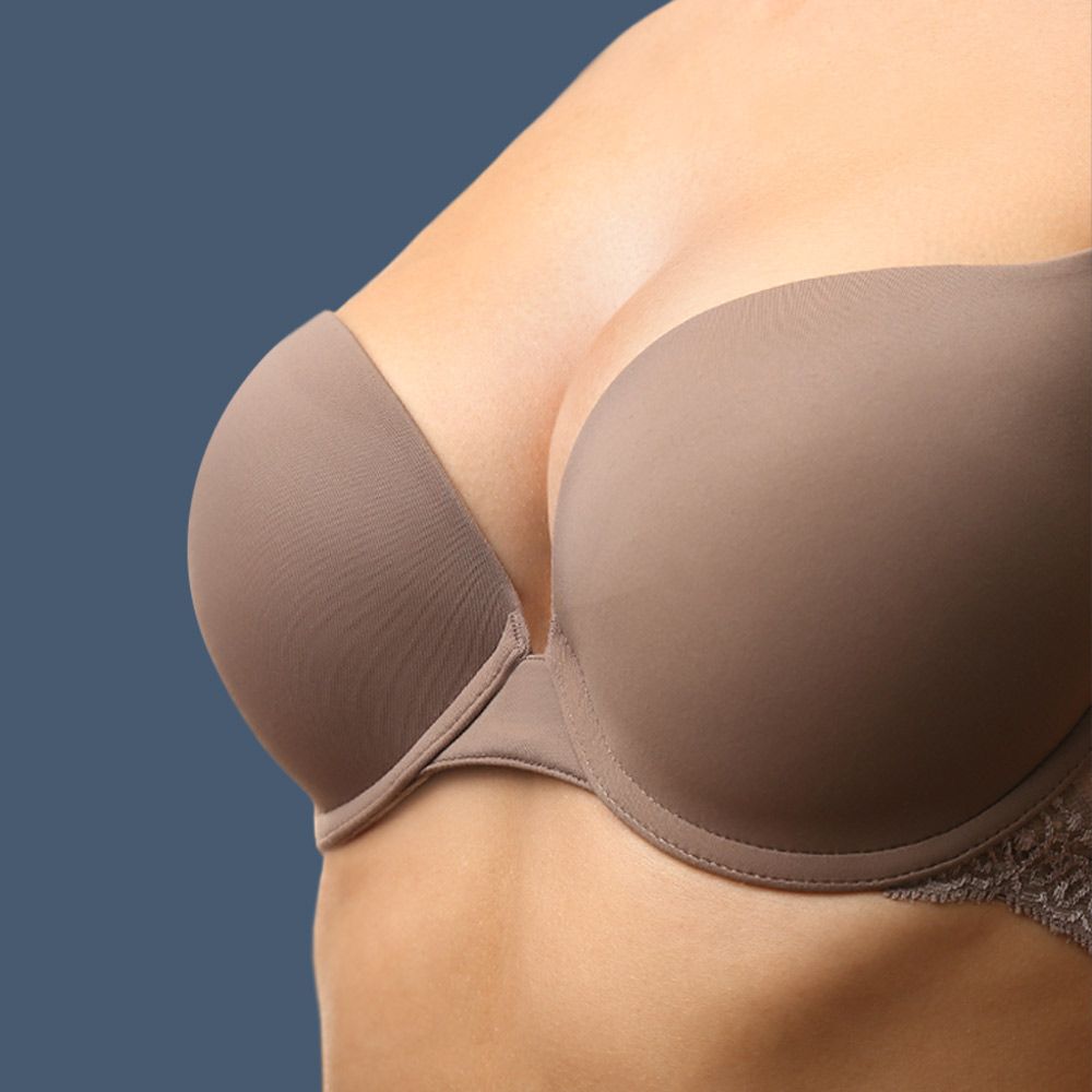 Woman before and after implant placement