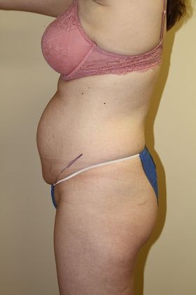 Dr. Bruce Hermann's patient before a tummy tuck