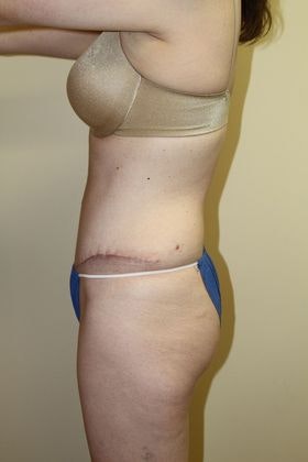 Dr. Bruce Hermann's patient after a tummy tuck