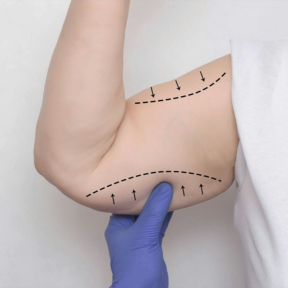 Person with arm lift markings on upper arm