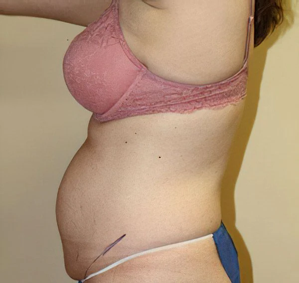 Mommy makeover before photo