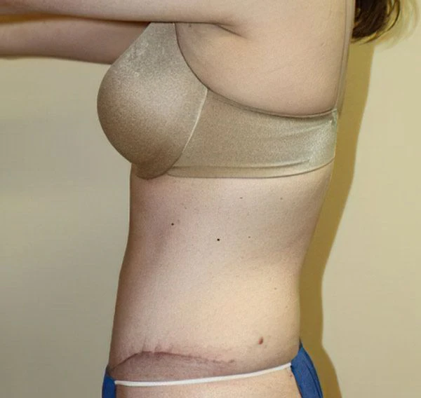Mommy makeover after photo