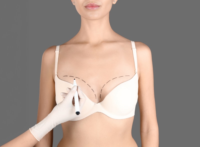 Woman with breast revision marker lines