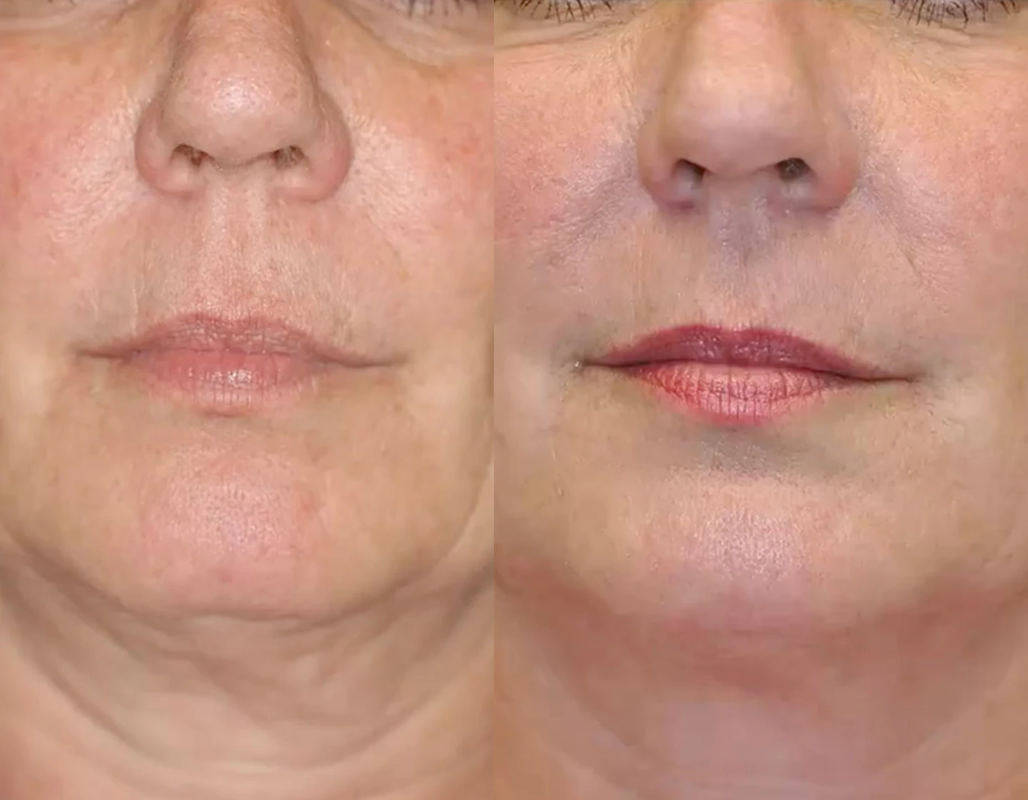 woman before and after facelift